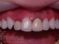 충치에 의한 치아와 잇몸 경계면 변색을 라미네이트로 치료.jpg