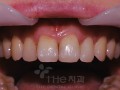 치아경계면 충치 및 변색을 라미네이트로 치료.jpg