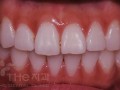 치아경계면 충치 및 변색을 라미네이트로 치료 - 비포어.jpg