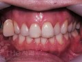 변색되고 부러진 치아를 라미네이트로 치료한 사례 - 비포어.jpg